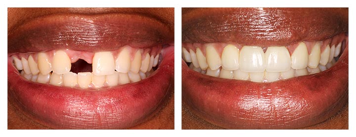 dental crowns and bridges before and after photos