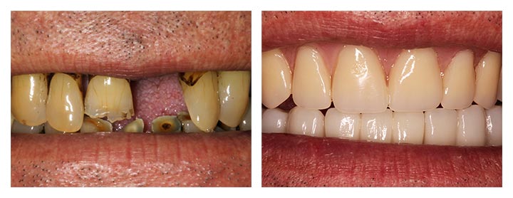 dental implant dentures before and after photos